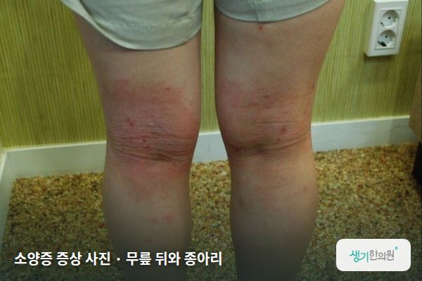 무릎 뒤와 종아리에 생긴 소양증 증상 사진 — 소양증 증상 사진 · 무릎 뒤와 종아리