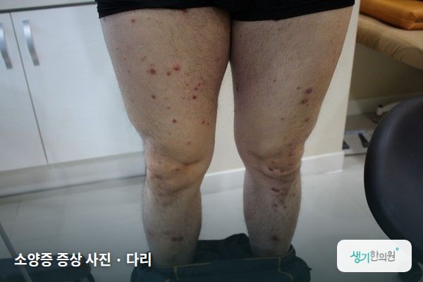 다리에 생긴 소양증 증상 사진 — 소양증 증상 사진 · 다리