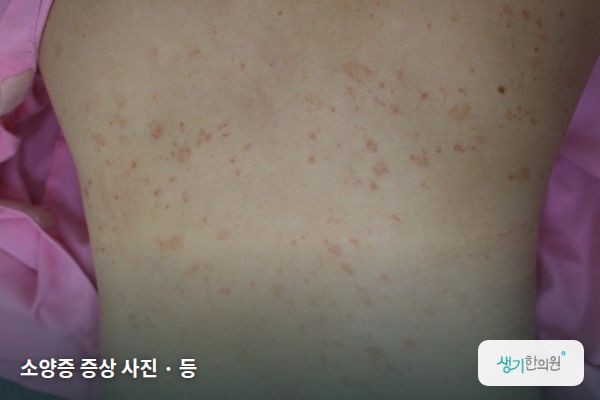 등에 생긴 소양증 증상 사진 — 소양증 증상 사진 · 등