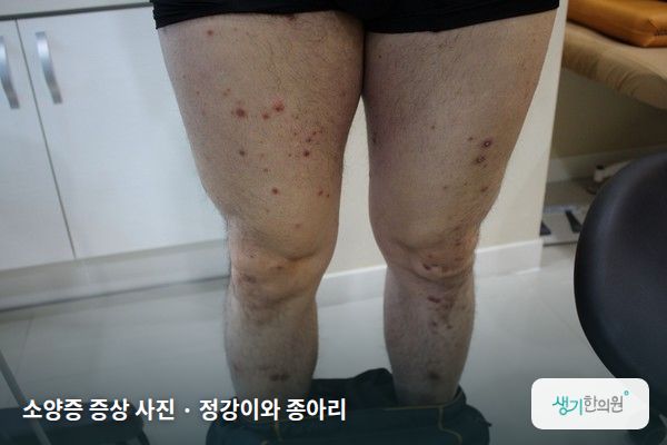 정강이와 종아리에 생긴 소양증 증상 사진 — 소양증 증상 사진 · 정강이와 종아리