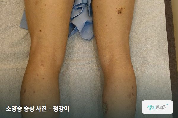 정강이에 생긴 소양증 증상 사진 — 소양증 증상 사진 · 정강이