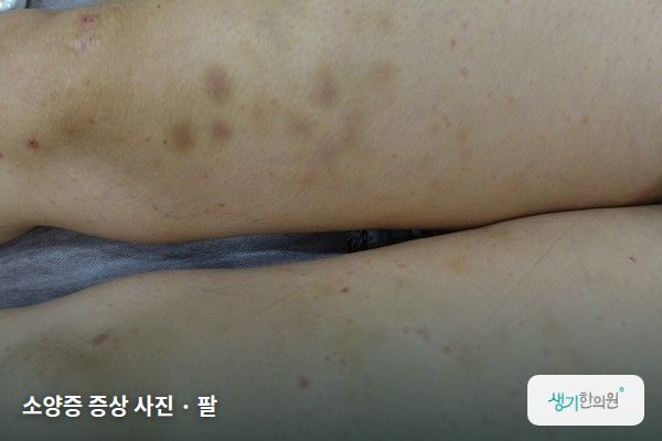 팔에 생긴 소양증 증상 사진 — 소양증 증상 사진 · 팔