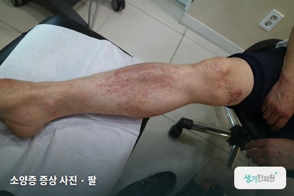 팔에 생긴 소양증 증상 사진