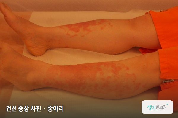 종아리에 생긴 건선 증상 사진 — 건선 증상 사진 · 종아리
