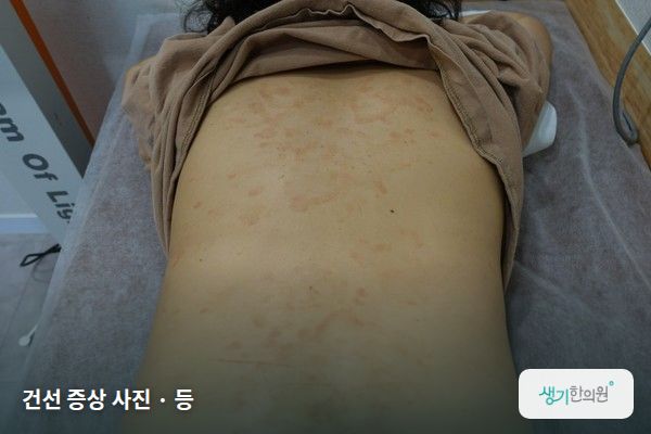 등에 생긴 건선 증상 사진 — 건선 증상 사진 · 등