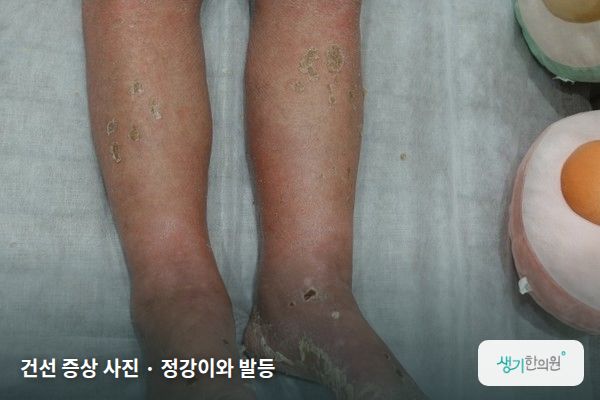 정강이와 발등에 생긴 건선 증상 사진 — 건선 증상 사진 · 정강이와 발등