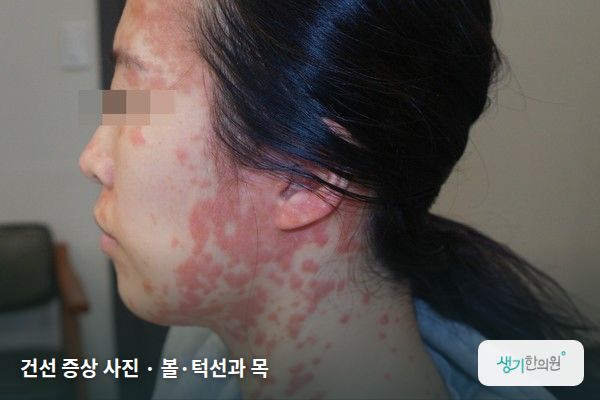 볼·턱선과 목에 생긴 건선 증상 사진 — 건선 증상 사진 · 볼·턱선과 목