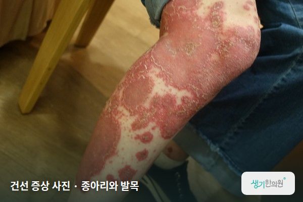 종아리와 발목에 생긴 건선 증상 사진 — 건선 증상 사진 · 종아리와 발목