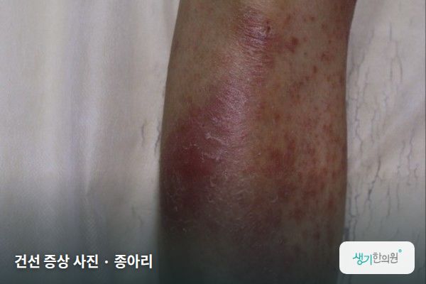 종아리에 생긴 건선 증상 사진 — 건선 증상 사진 · 종아리