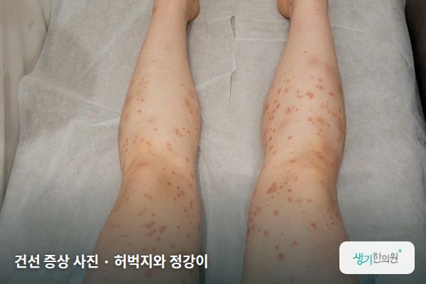 허벅지와 정강이에 생긴 건선 증상 사진 — 건선 증상 사진 · 허벅지와 정강이