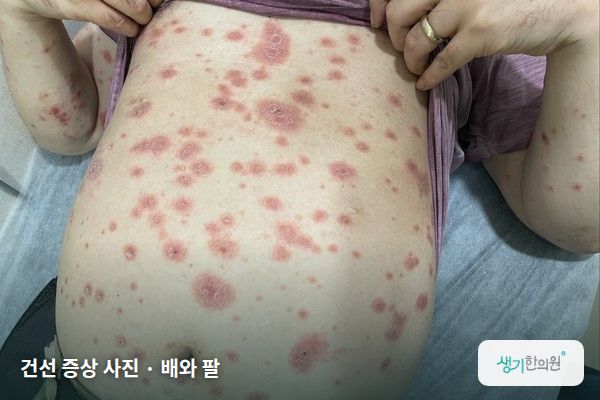 배와 팔에 생긴 건선 증상 사진 — 건선 증상 사진 · 배와 팔