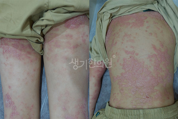 허벅지와 옆구리의 건선 증상 사진
