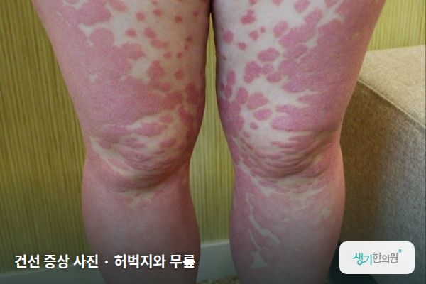 허벅지와 무릎에 생긴 건선 증상 사진 — 건선 증상 사진 · 허벅지와 무릎