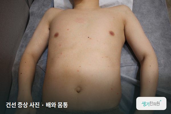 배와 몸통에 생긴 건선 증상 사진 — 건선 증상 사진 · 배와 몸통