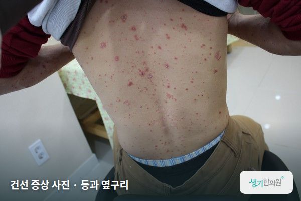 등과 옆구리에 생긴 건선 증상 사진 — 건선 증상 사진 · 등과 옆구리