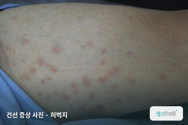 허벅지에 생긴 건선 증상 사진 — 건선 증상 사진 · 허벅지