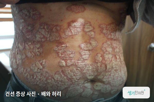 배와 허리에 생긴 건선 증상 사진 — 건선 증상 사진 · 배와 허리