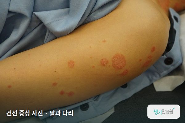 팔과 다리에 생긴 건선 증상 사진 — 건선 증상 사진 · 팔과 다리