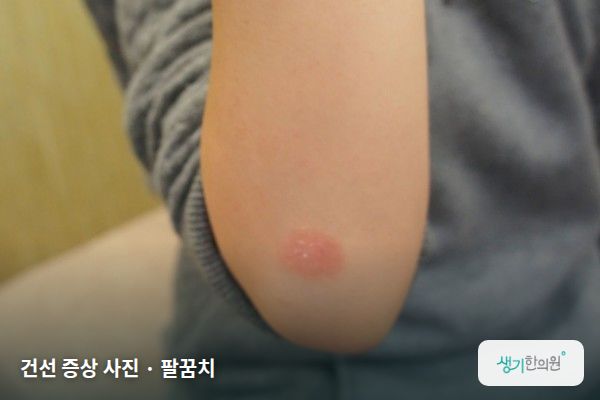 팔꿈치에 생긴 건선 증상 사진 — 건선 증상 사진 · 팔꿈치
