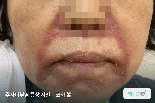 코와 볼에 생긴 주사피부염 증상 사진 — 주사피부염 증상 사진 · 코와 볼