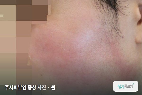 볼에 생긴 주사피부염 증상 사진 — 주사피부염 증상 사진 · 볼