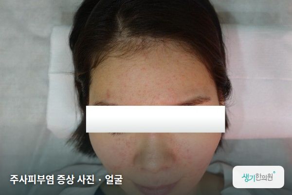 얼굴에 생긴 주사피부염 증상 사진 — 주사피부염 증상 사진 · 얼굴
