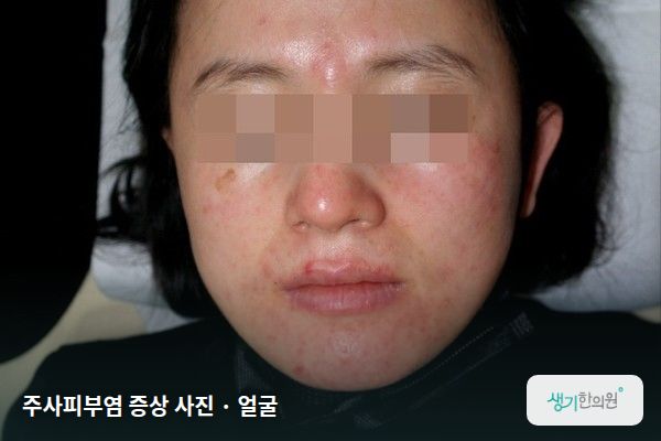 얼굴에 생긴 주사피부염 증상 사진 — 주사피부염 증상 사진 · 얼굴