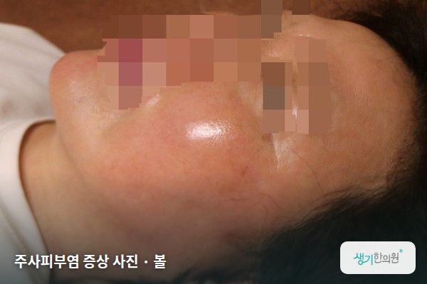 볼에 생긴 주사피부염 증상 사진 — 주사피부염 증상 사진 · 볼