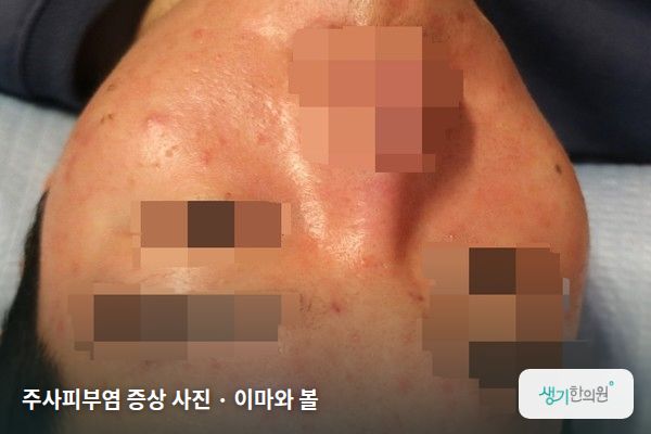 이마와 볼에 생긴 주사피부염 증상 사진 — 주사피부염 증상 사진 · 이마와 볼