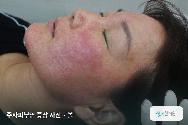 볼에 생긴 주사피부염 증상 사진 — 주사피부염 증상 사진 · 볼