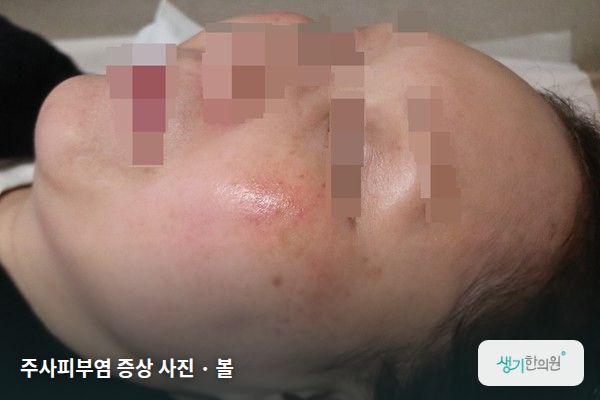 볼에 생긴 주사피부염 증상 사진
