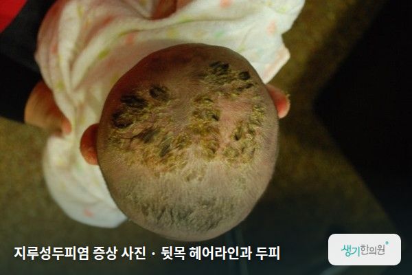 뒷목 헤어라인과 두피에 생긴 지루성두피염 증상 사진 — 지루성두피염 증상 사진 · 뒷목 헤어라인과 두피