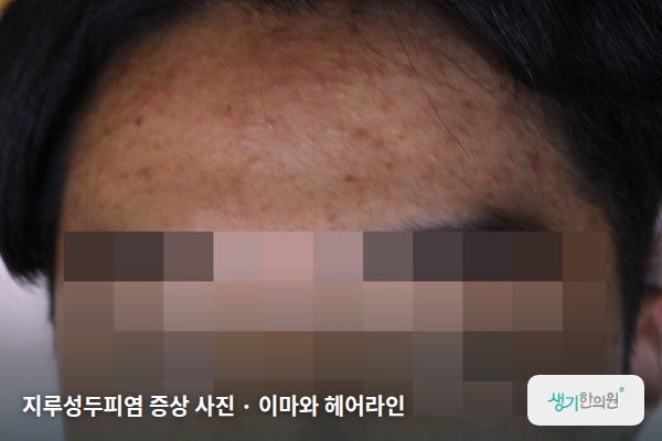이마와 헤어라인에 생긴 지루성두피염 증상 사진 — 지루성두피염 증상 사진 · 이마와 헤어라인