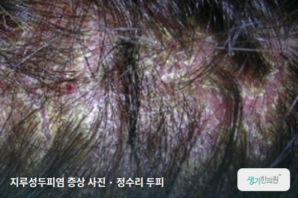 정수리 두피에 생긴 지루성두피염 증상 사진 — 지루성두피염 증상 사진 · 정수리 두피