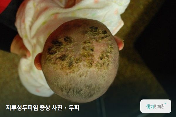 두피에 생긴 지루성두피염 증상 사진 — 지루성두피염 증상 사진 · 두피