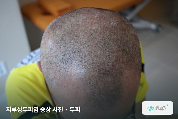 두피에 생긴 지루성두피염 증상 사진 — 지루성두피염 증상 사진 · 두피