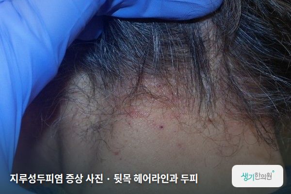뒷목 헤어라인과 두피에 생긴 지루성두피염 증상 사진 — 지루성두피염 증상 사진 · 뒷목 헤어라인과 두피