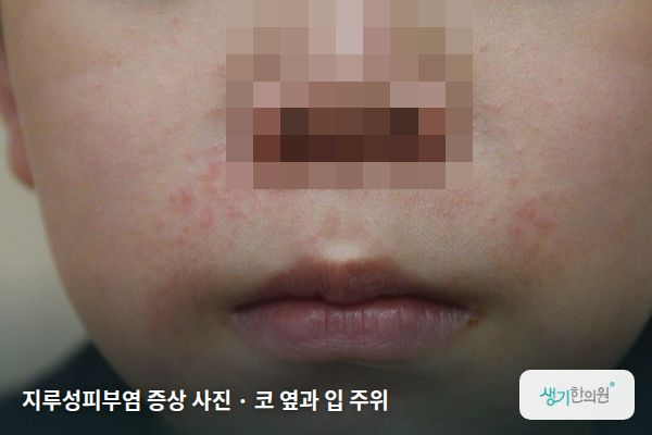코 옆과 입 주위에 생긴 지루성피부염 증상 사진 — 지루성피부염 증상 사진 · 코 옆과 입 주위