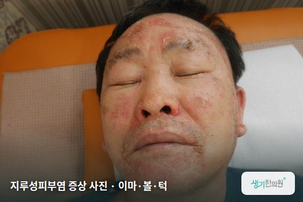 이마·볼·턱에 생긴 지루성피부염 증상 사진 — 지루성피부염 증상 사진 · 이마·볼·턱