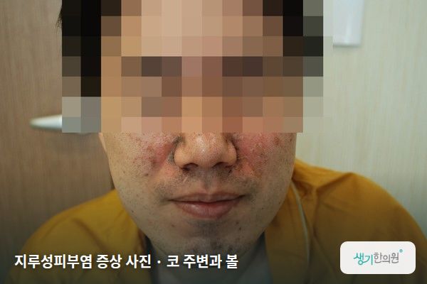코 주변과 볼에 생긴 지루성피부염 증상 사진 — 지루성피부염 증상 사진 · 코 주변과 볼