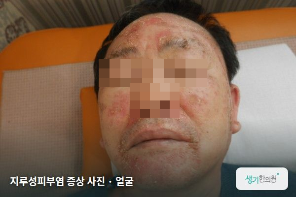 얼굴에 생긴 지루성피부염 증상 사진 — 지루성피부염 증상 사진 · 얼굴