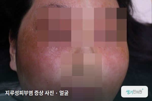 얼굴에 생긴 지루성피부염 증상 사진 — 지루성피부염 증상 사진 · 얼굴