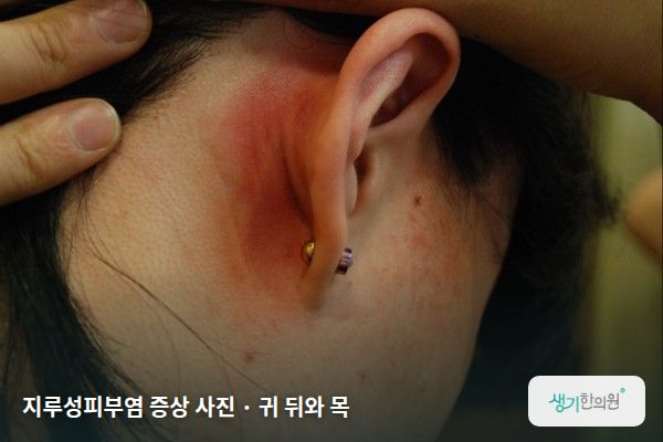 귀 뒤와 목에 생긴 지루성피부염 증상 사진 — 지루성피부염 증상 사진 · 귀 뒤와 목