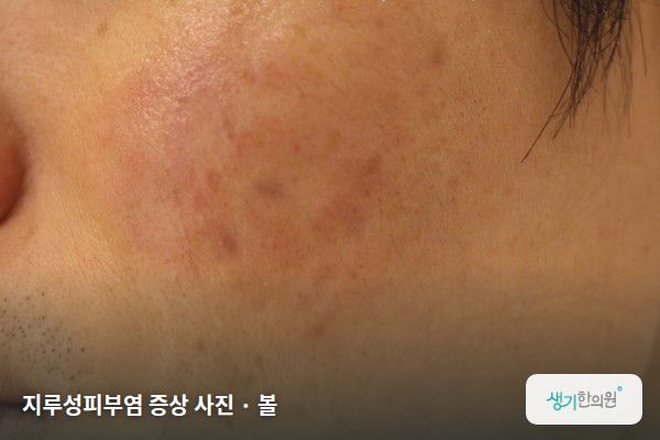 볼에 생긴 지루성피부염 증상 사진 — 지루성피부염 증상 사진 · 볼