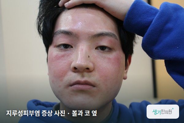 볼과 코 옆에 생긴 지루성피부염 증상 사진 — 지루성피부염 증상 사진 · 볼과 코 옆