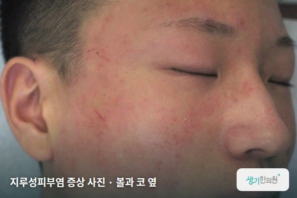 볼과 코 옆에 생긴 지루성피부염 증상 사진 — 지루성피부염 증상 사진 · 볼과 코 옆