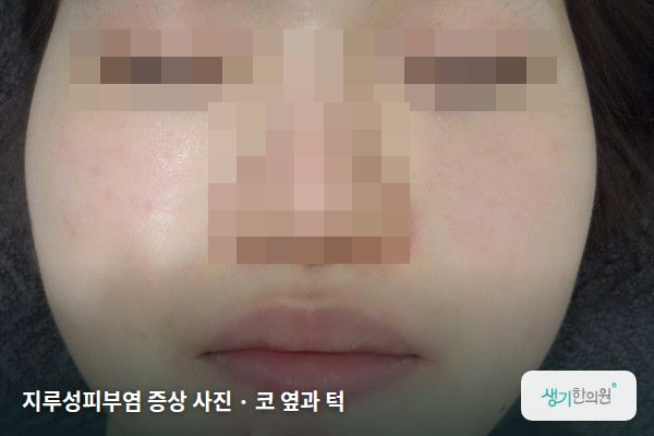 코 옆과 턱에 생긴 지루성피부염 증상 사진 — 지루성피부염 증상 사진 · 코 옆과 턱