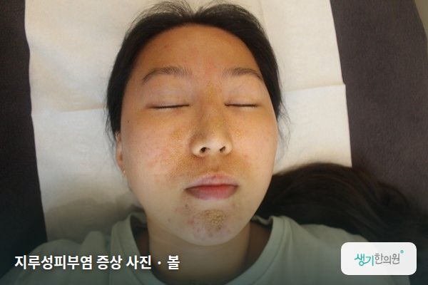 볼에 생긴 지루성피부염 증상 사진 — 지루성피부염 증상 사진 · 볼
