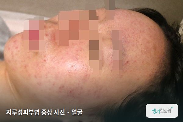얼굴에 생긴 지루성피부염 증상 사진