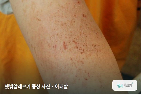 아래팔에 생긴 햇빛알레르기 증상 사진 — 햇빛알레르기 증상 사진 · 아래팔